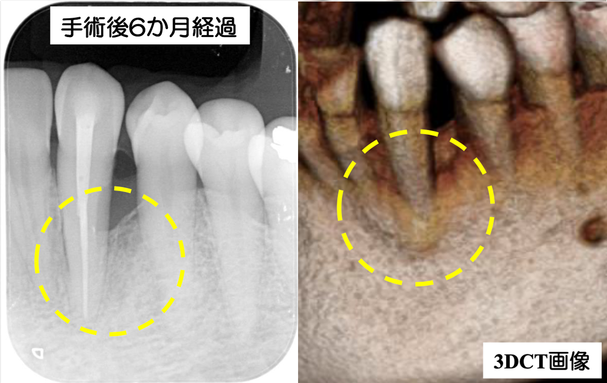 歯周組織再生治療(リグロス®︎)