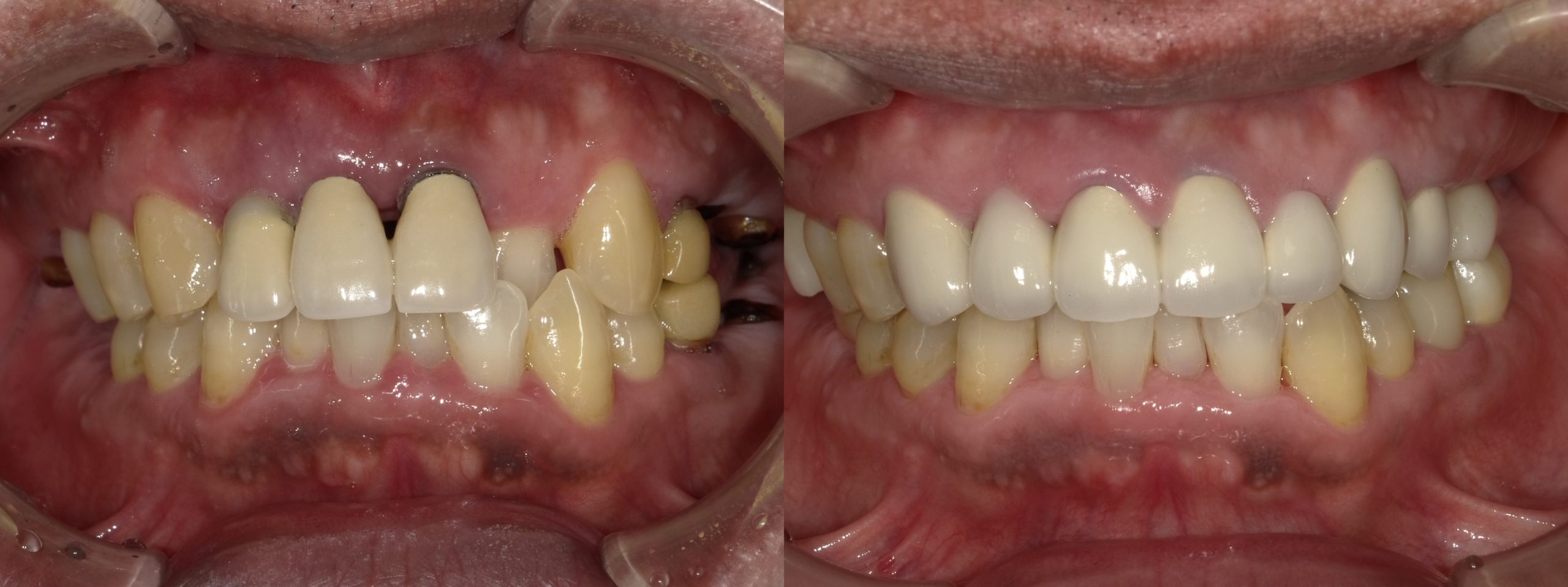 大臼歯部にインプラントを用いて咬合を確保し、前歯部は歯の移植を用いて審美性を獲得した症例
