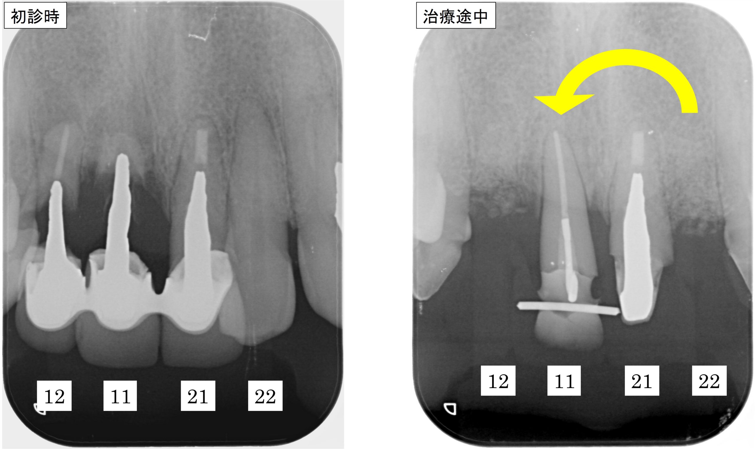 22→11　歯の移植