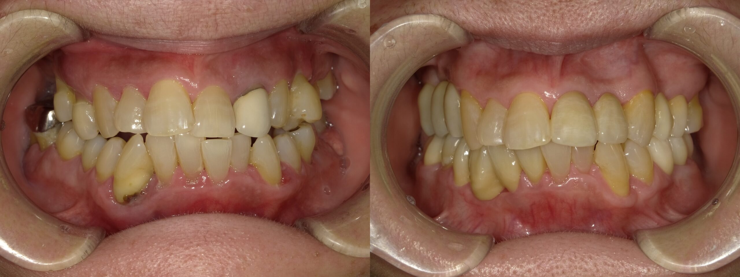 重度歯周病患者に対して歯周組織再生とインプラントを用いた全顎的治療