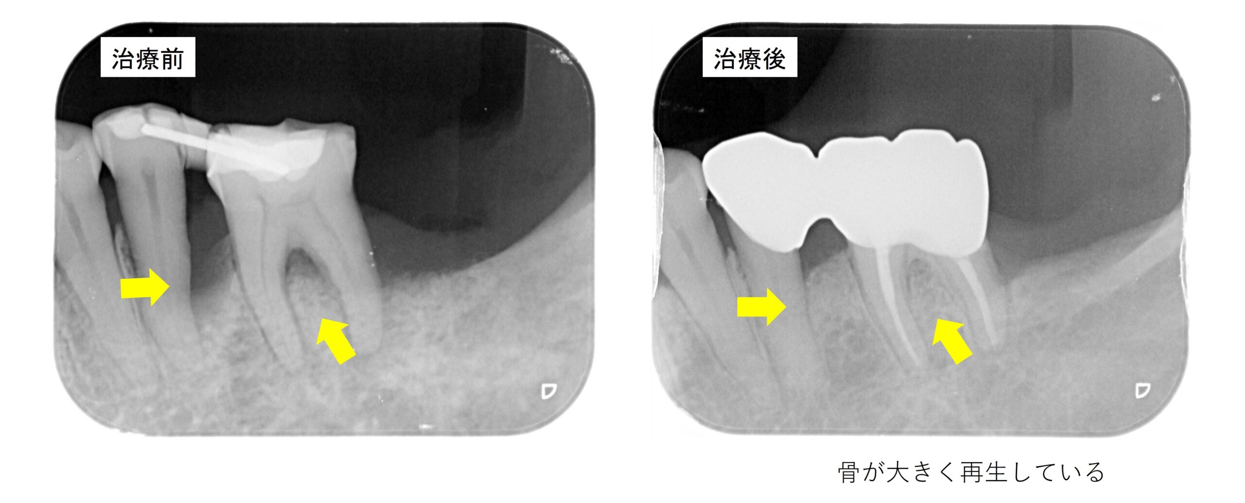 左下６の歯周組織再生治療
