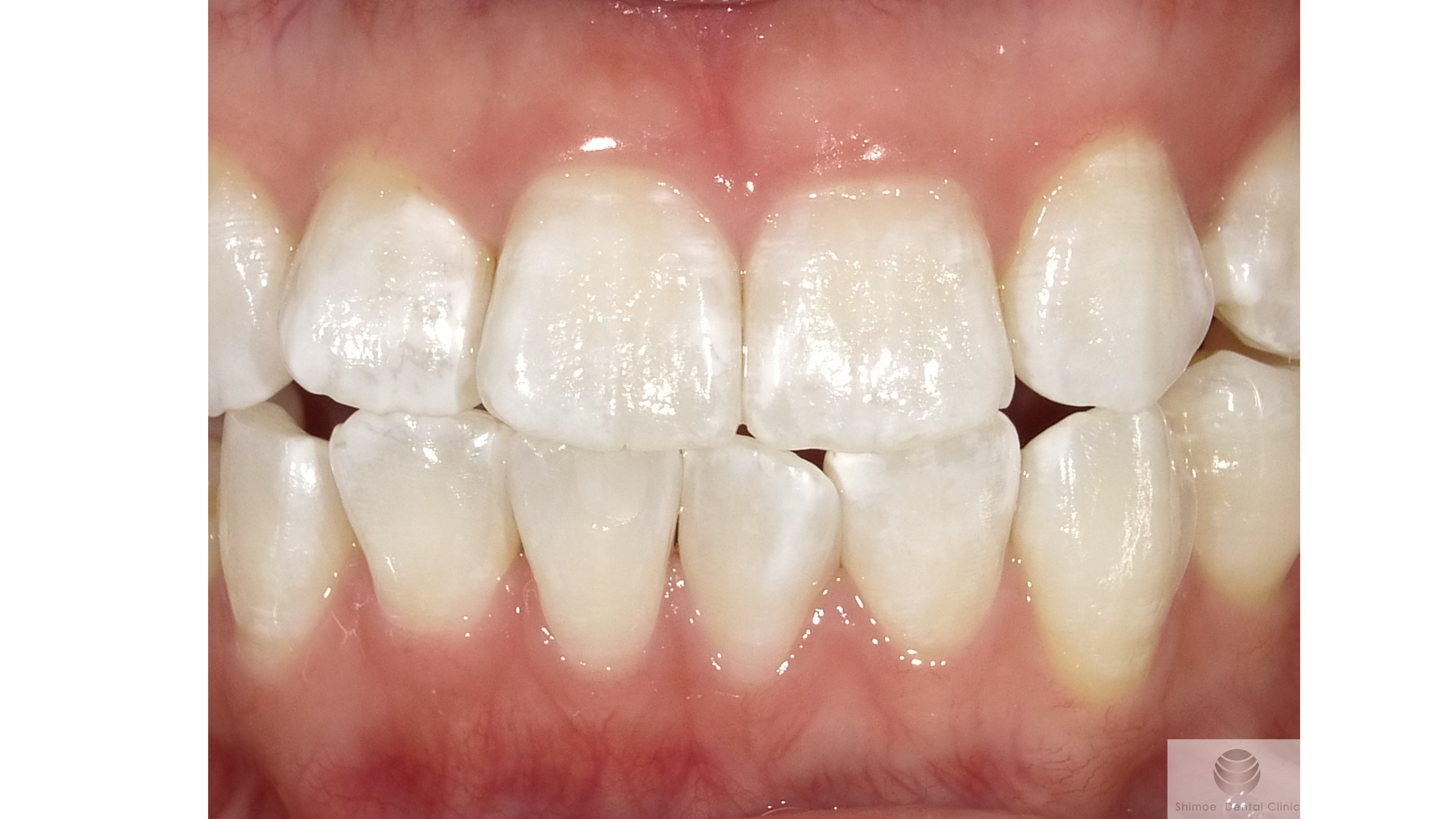 ホワイトスポット治療直後