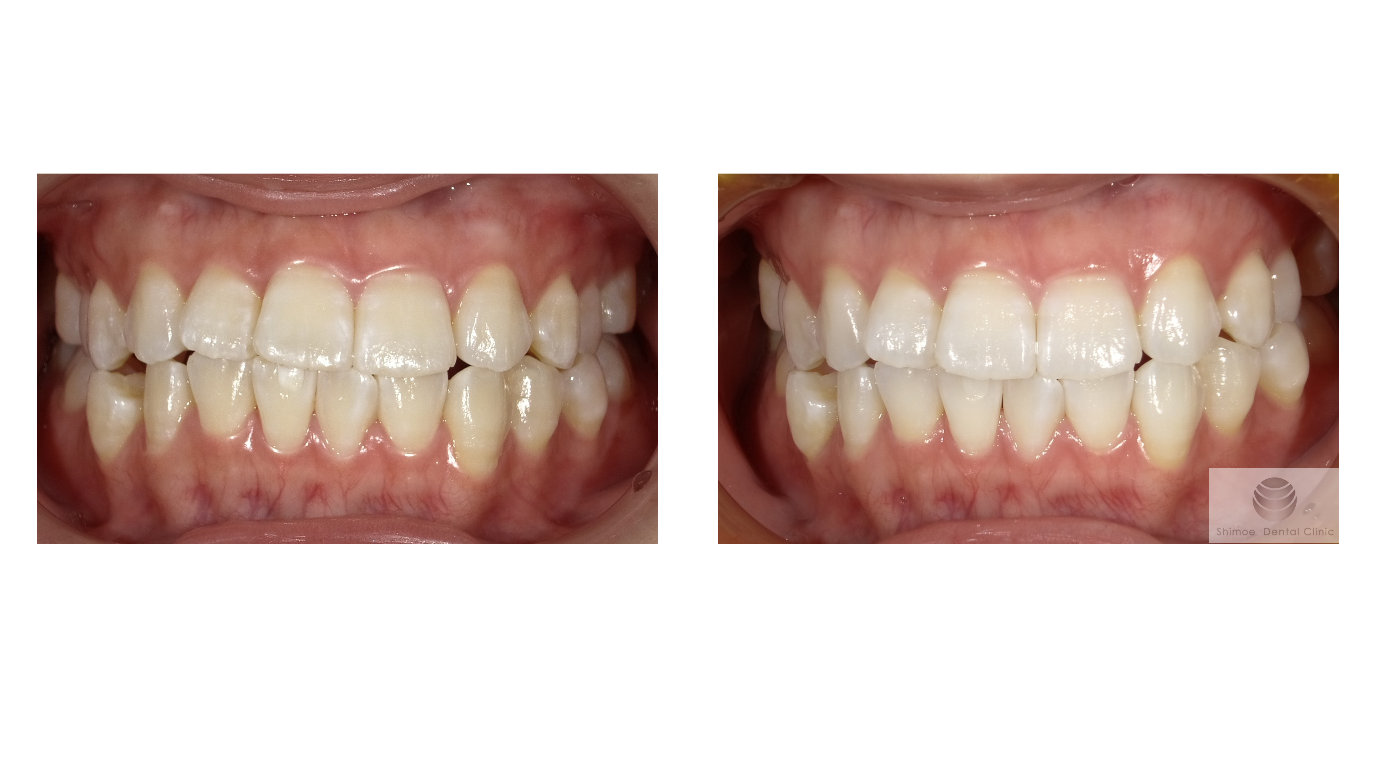 口腔内全体の比較写真
