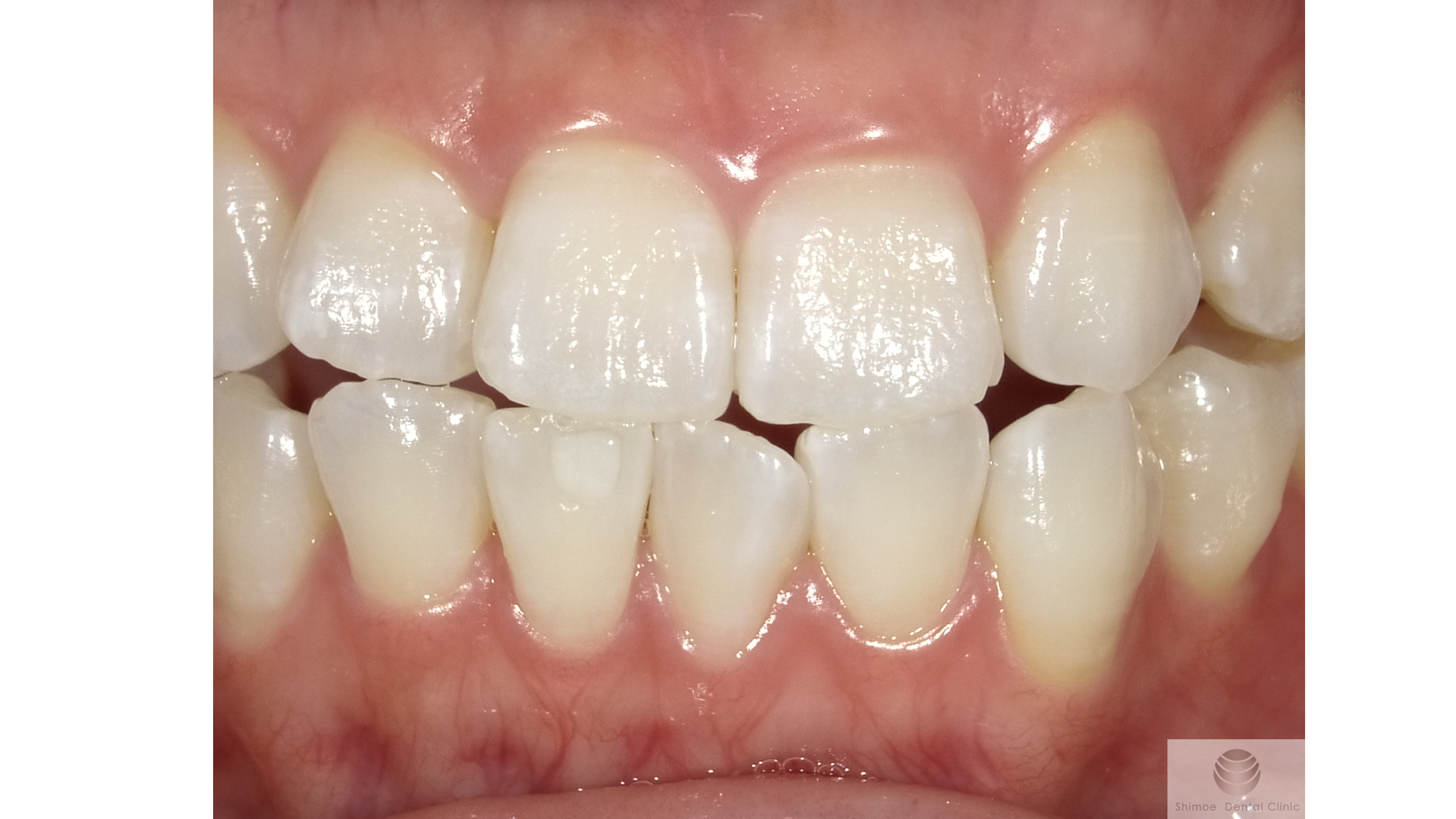 ホワイトニング後