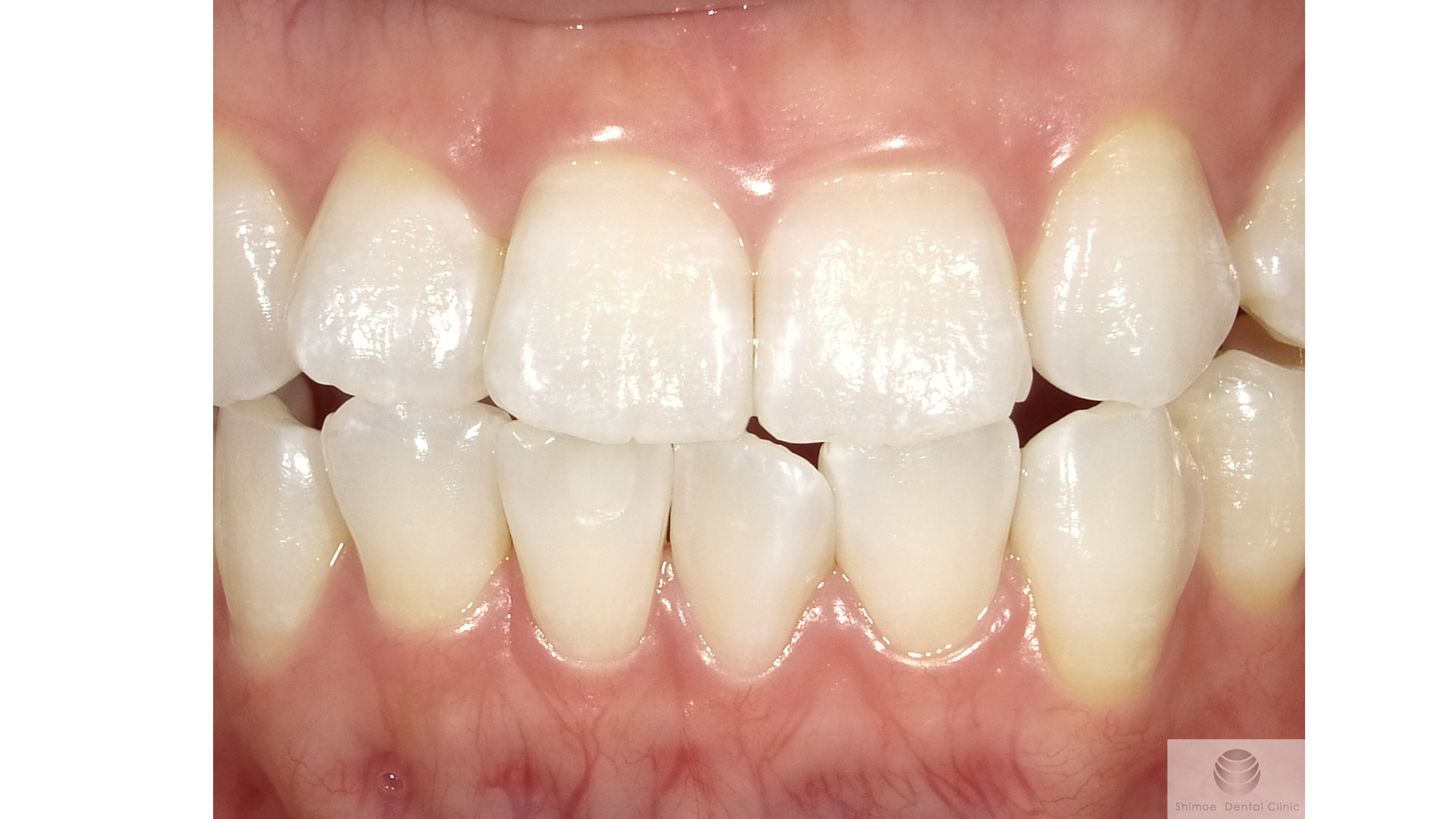 ホワイトスポット治療から１か月後