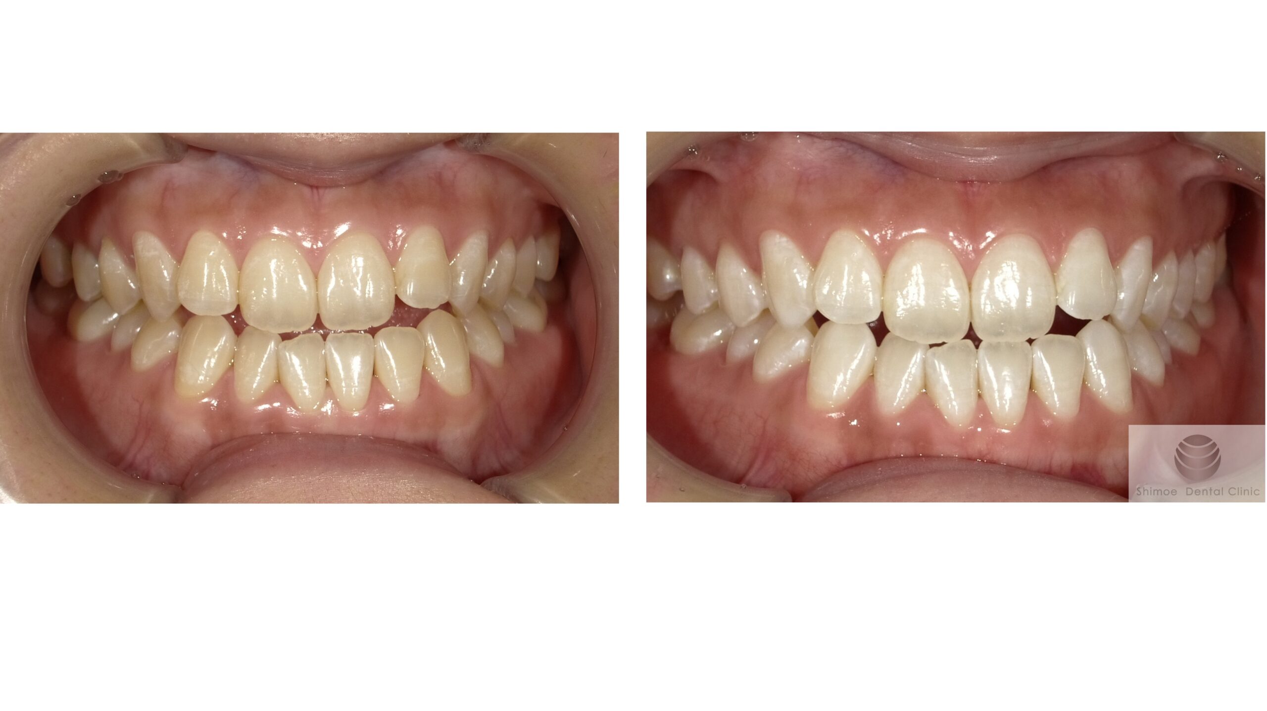 黄ばみの強い方のデュアルホワイトニング