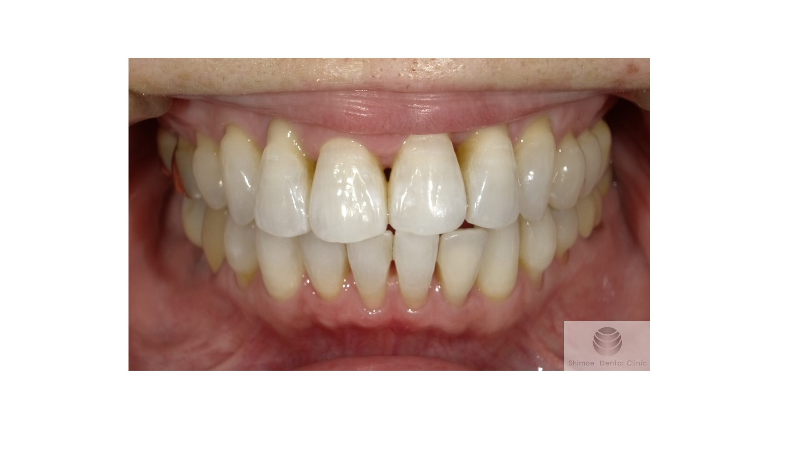 １年後　再オフィスホワイトニング