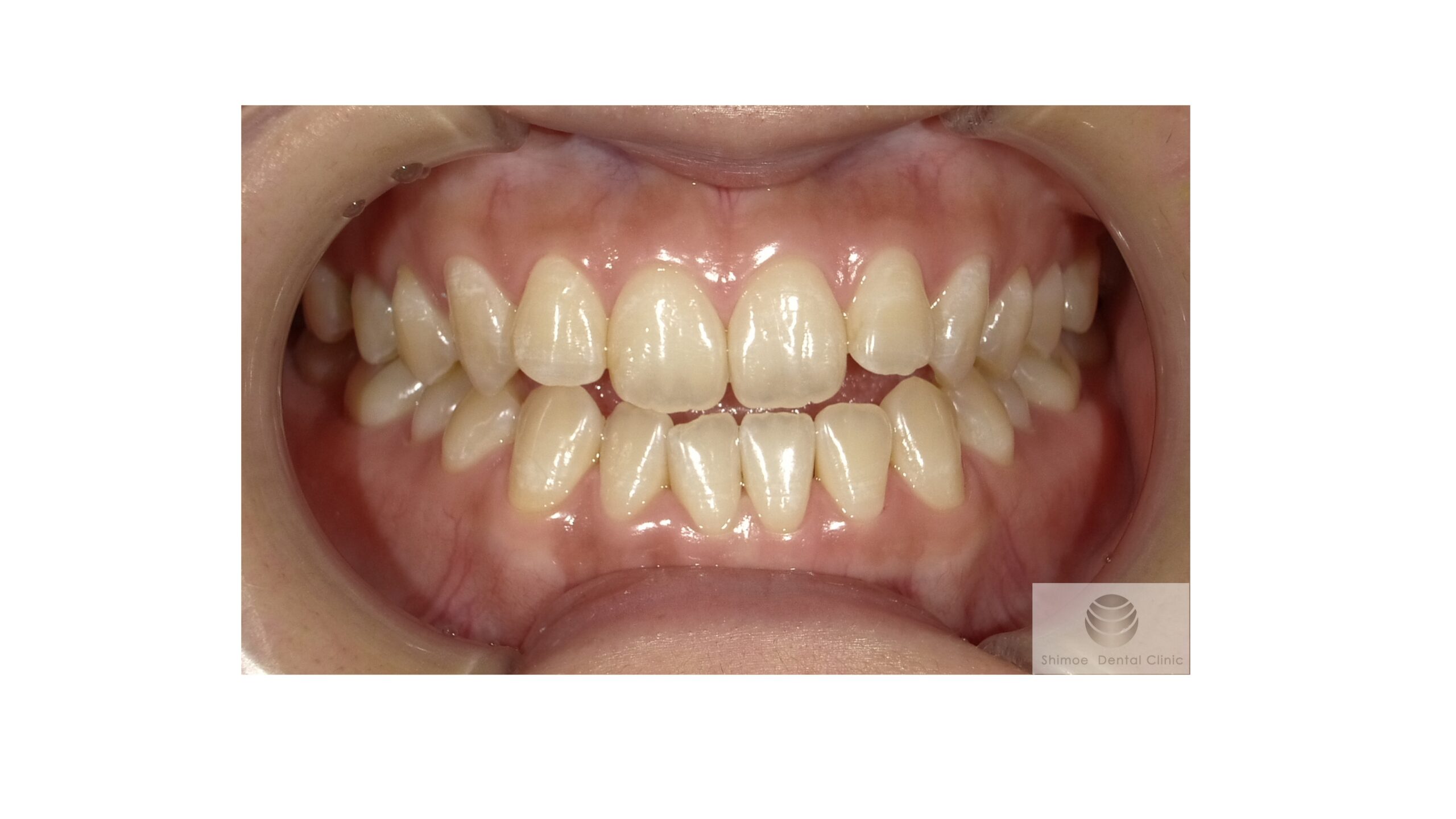 ホワイトニング前