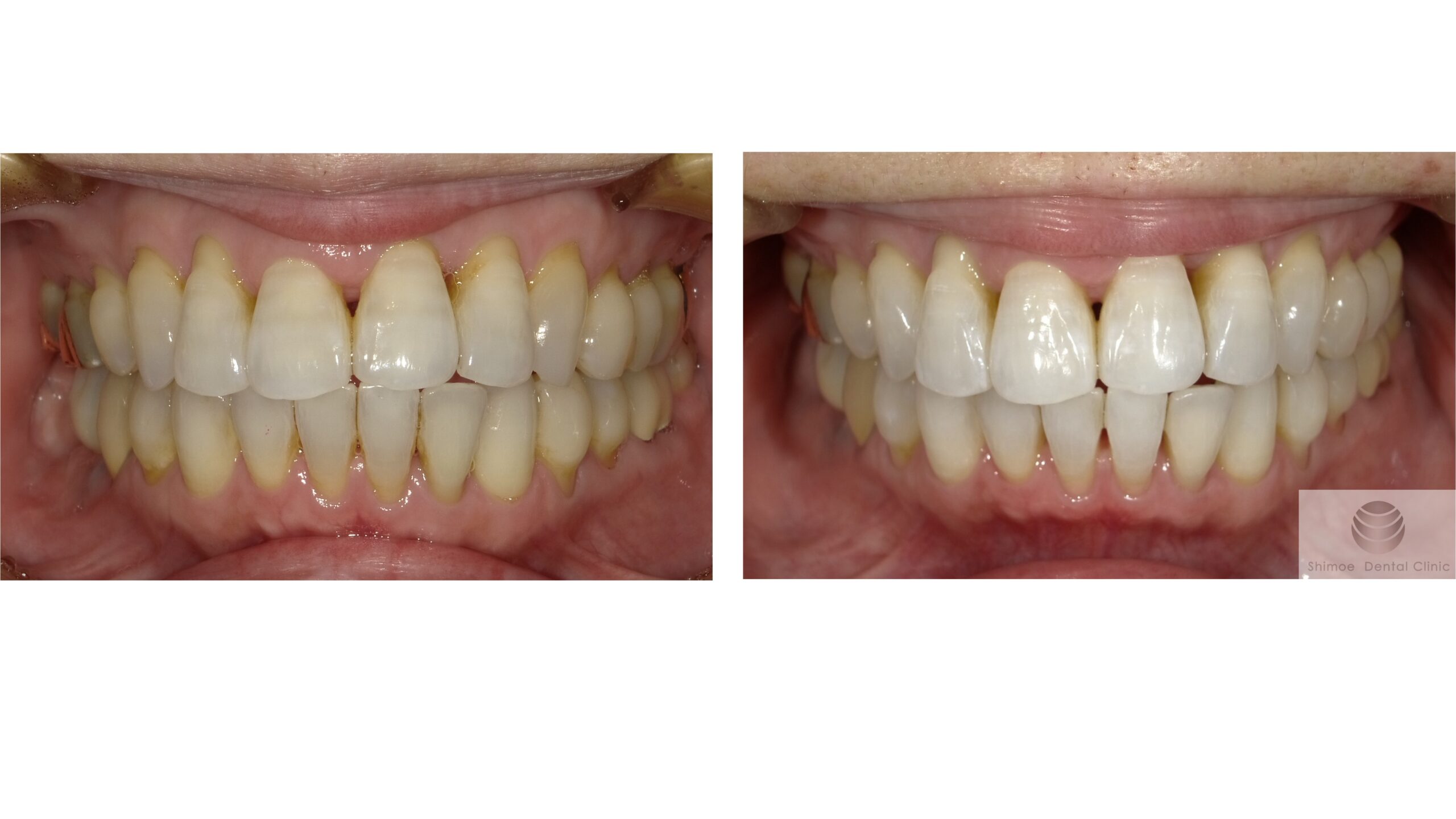 過去にホワイトニングご経験のある方のデュアルホワイトニング