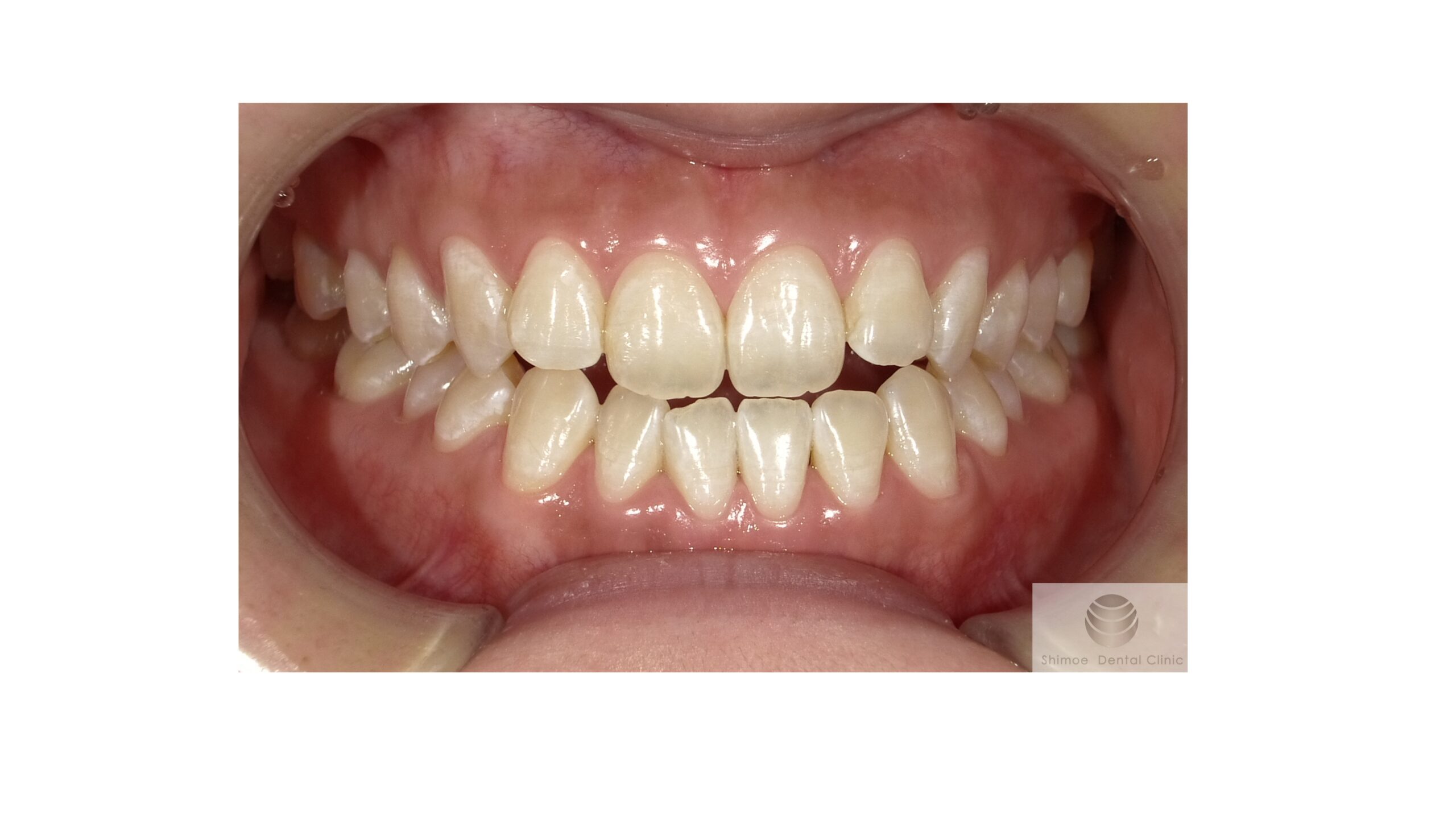 オフィスホワイトニング１回目後